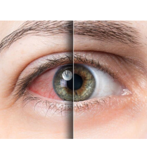 Bindehautentzündung